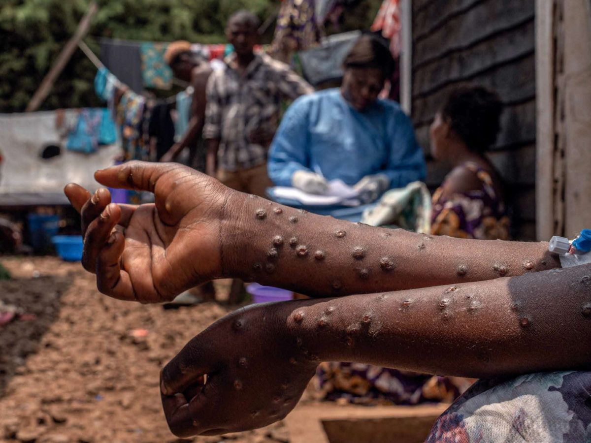 Risque de pandémie / Un cri d’alarme pour juguler la propagation du virus mpox en Afrique